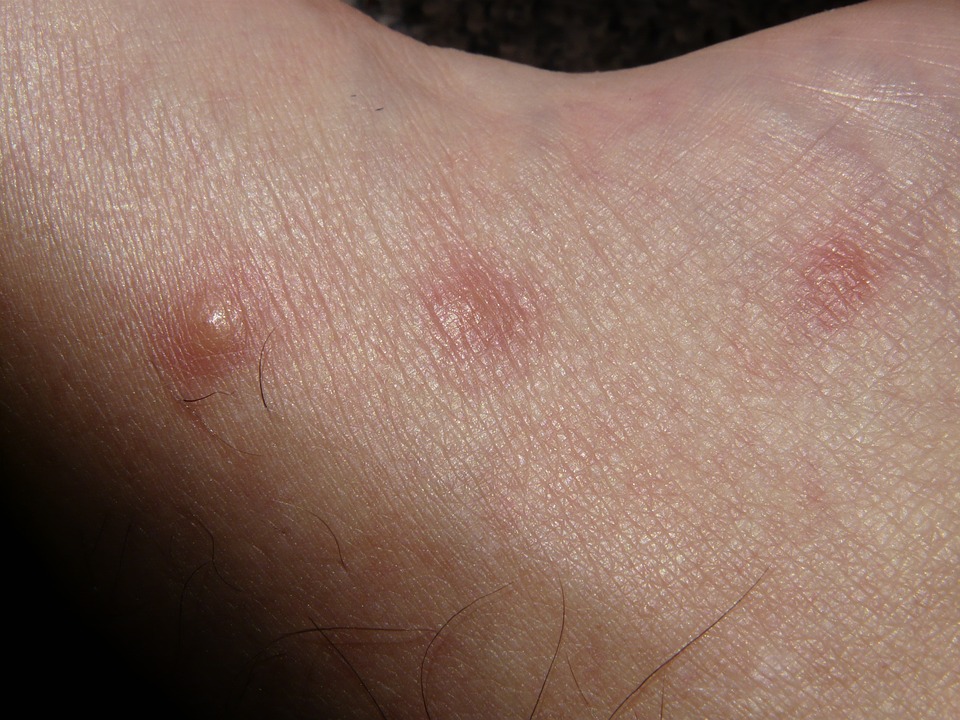 Hives vs Angioedema Hives vs Angioedema