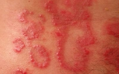 Are Allergies Causing my Eczema?